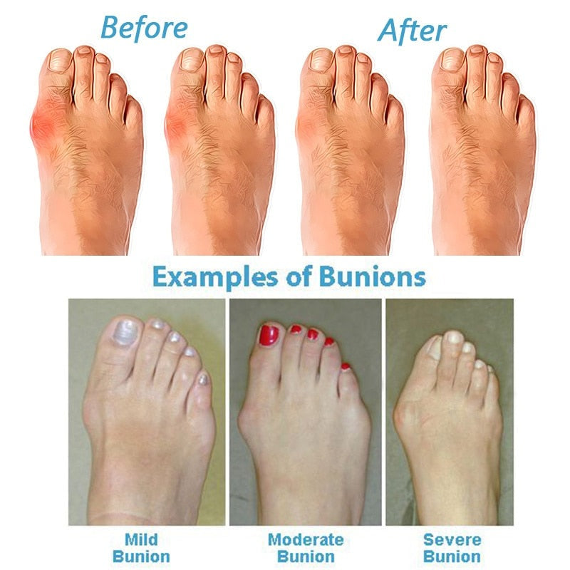 Korrigierende Sandalen für Hornhautschwielen - OrthoSole