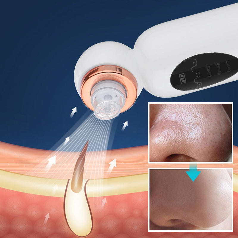 Pore Extractor and Hydrodermabrasion - HydraGlow