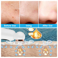 Pore Extractor and Hydrodermabrasion - HydraGlow