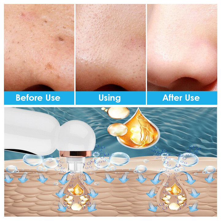 Pore Extractor and Hydrodermabrasion - HydraGlow