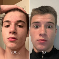 Voor-en-nafoto van het gezicht van een jonge man, met onzuivere huid links en een rustiger huid rechts 3