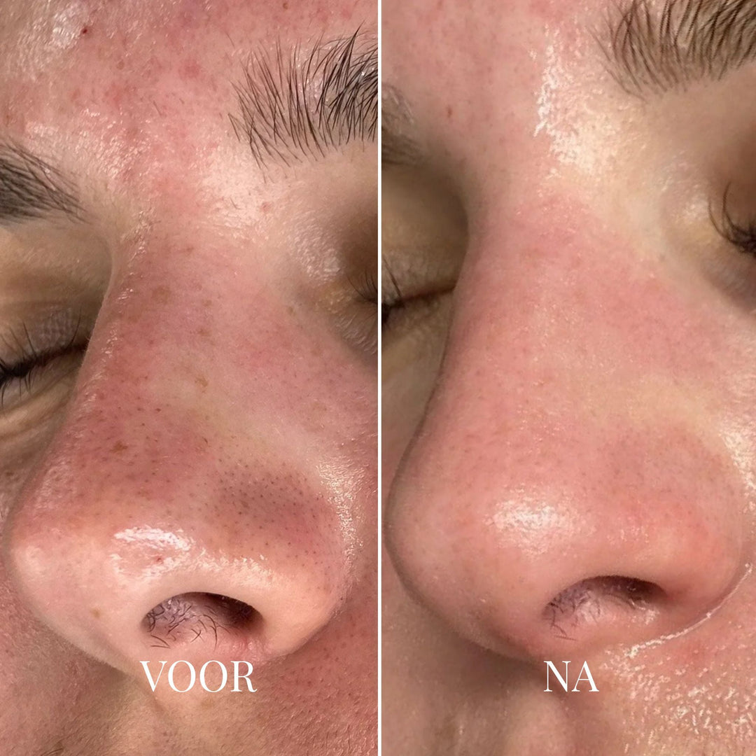 Voor-en-nafoto van een neus met zichtbare poriën links en een gladdere huid rechts 2
