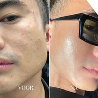 Voor-en-nafoto van een wang met oneffenheden links en een gladdere, glanzende huid rechts 7
