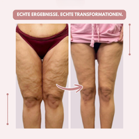 Voor-en-nabeeld van de bovenbenen en knieën van voren, met een pijl van de linkerfoto naar de rechterfoto en Duitse tekst. 12