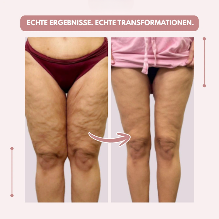 Voor-en-nabeeld van de bovenbenen en knieën van voren, met een pijl van de linkerfoto naar de rechterfoto en Duitse tekst. 12
