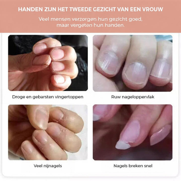 Collage van vier problemen: droge nagelriemen, ruw nageloppervlak, losse nagelriempjes en gemakkelijk brekende nagels 3