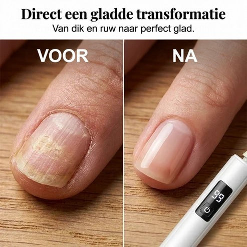 Voor-en-nafoto van een nagel: links dik en ruw met ribbels, rechts glad en gepolijst 4