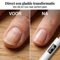 Voor-en-nafoto van een nagel: links dik en ruw met ribbels, rechts glad en gepolijst 4