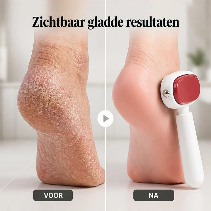 Vergelijking van een droge, gebarsten hiel vóór en een gladde hiel na gebruik van de vijl 2