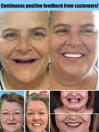 Flexible Denture Set for Upper & Lower Jaw – Reusable & Custom-Fit 3