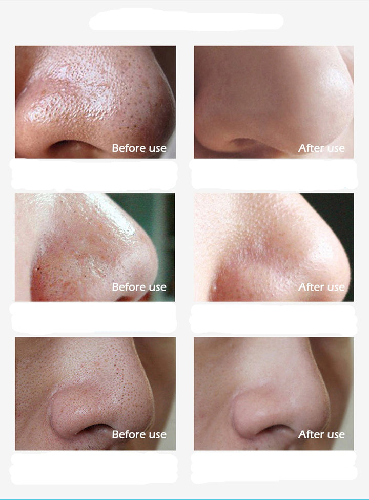 ClearSkin: Blackhead Remover